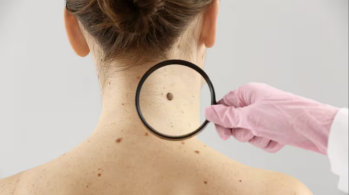 A woman getting the back of neck checked for a spot by a doctor with a magnifying glass.